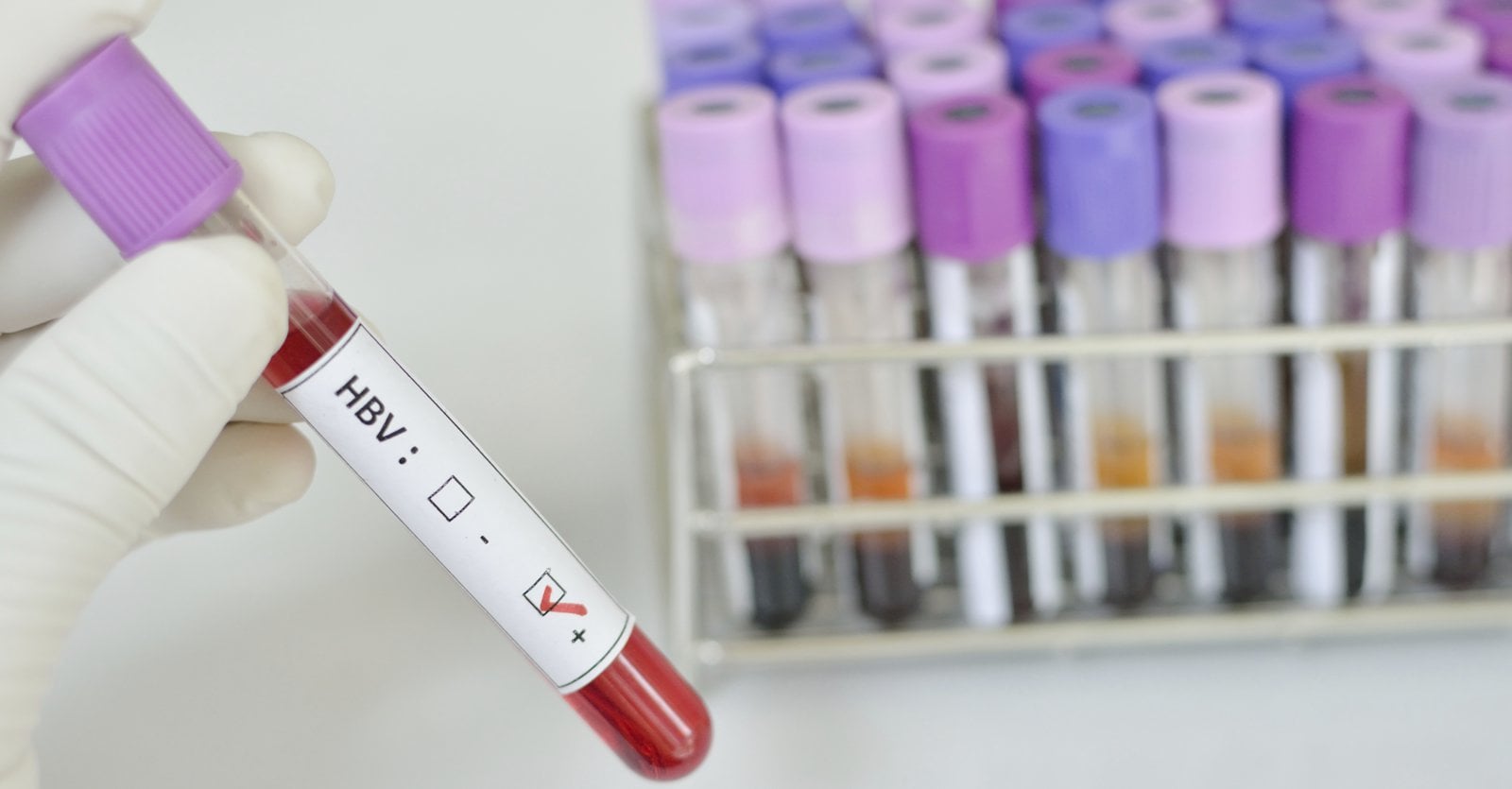 Анализ крови на гепатит B в «ЭКО-Содействие»