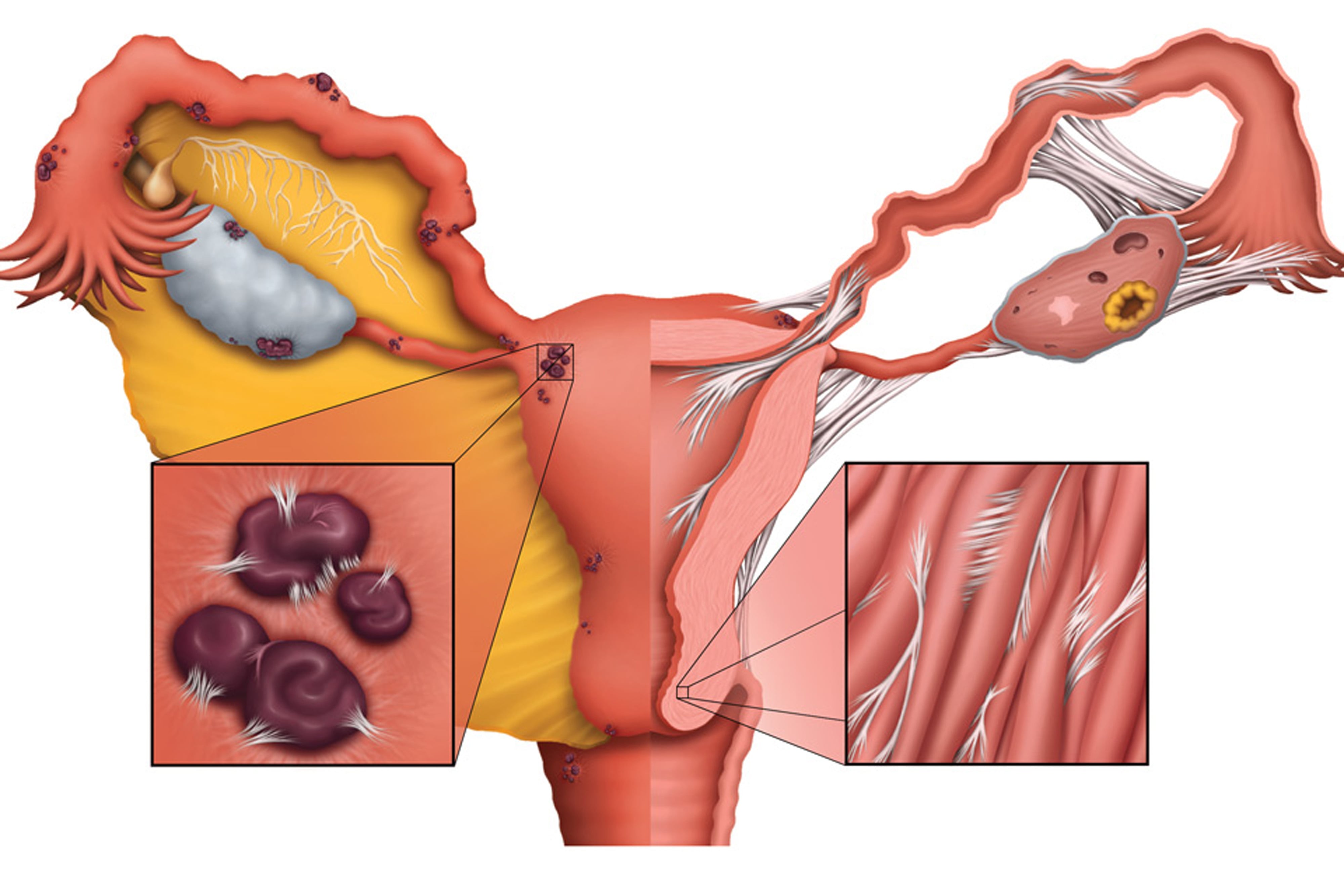 Эндометриоз