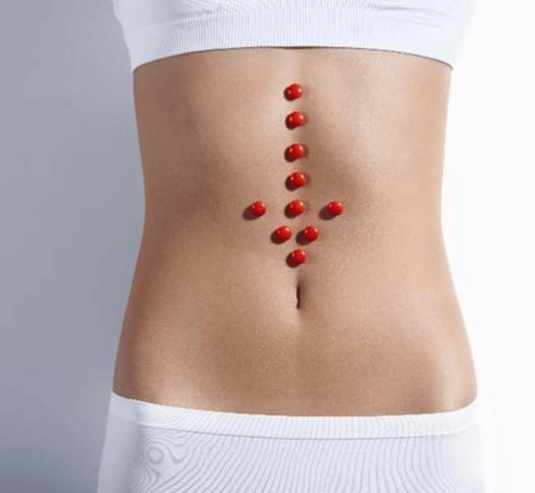 Лечение эндометриоза