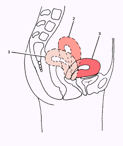 Загиб матки