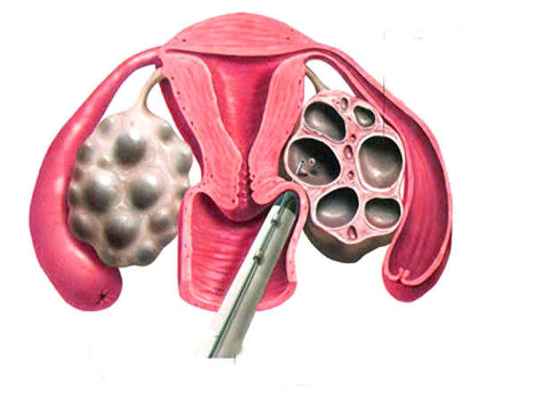 Как происходит пункция яичников при ЭКО