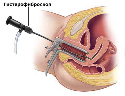 Гистероскопия