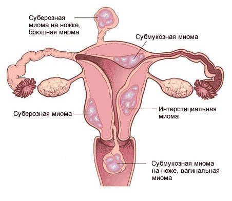 Миома матки
