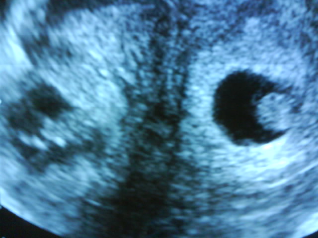 Внематочная беременность