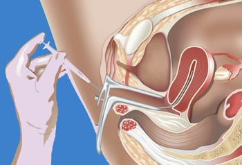 Внутриматочная искусственная инсеминация